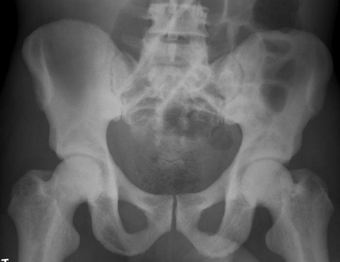 osteopetrosis चित्र